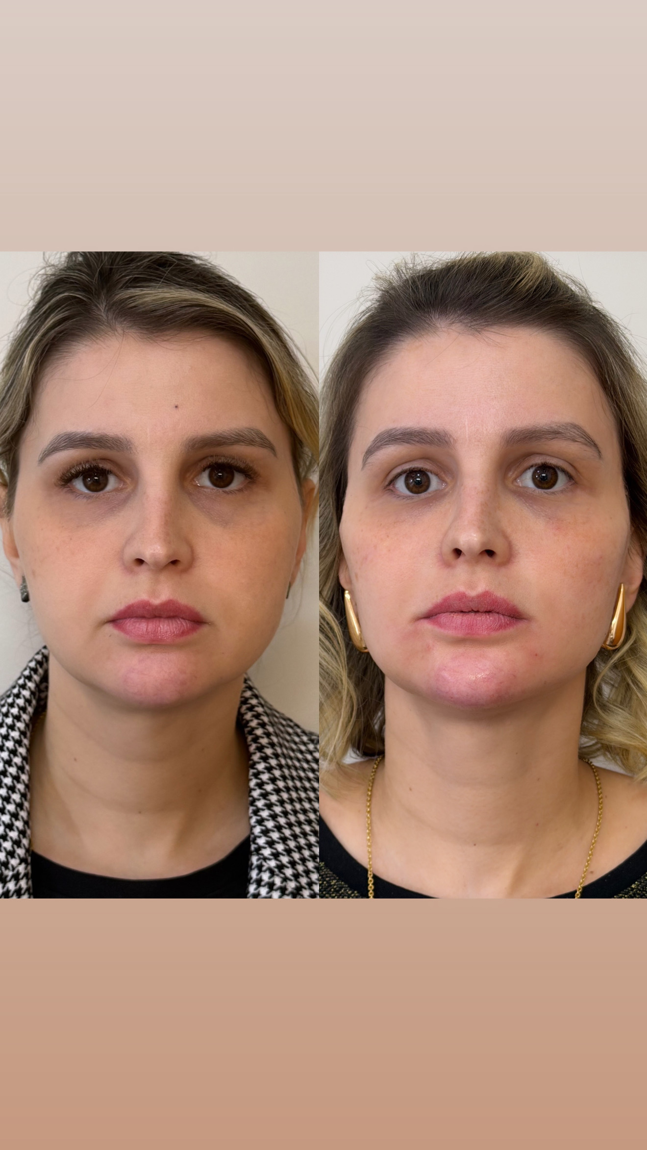 Resultado antes e depois