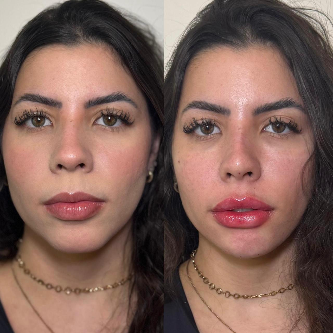 Resultado antes e depois