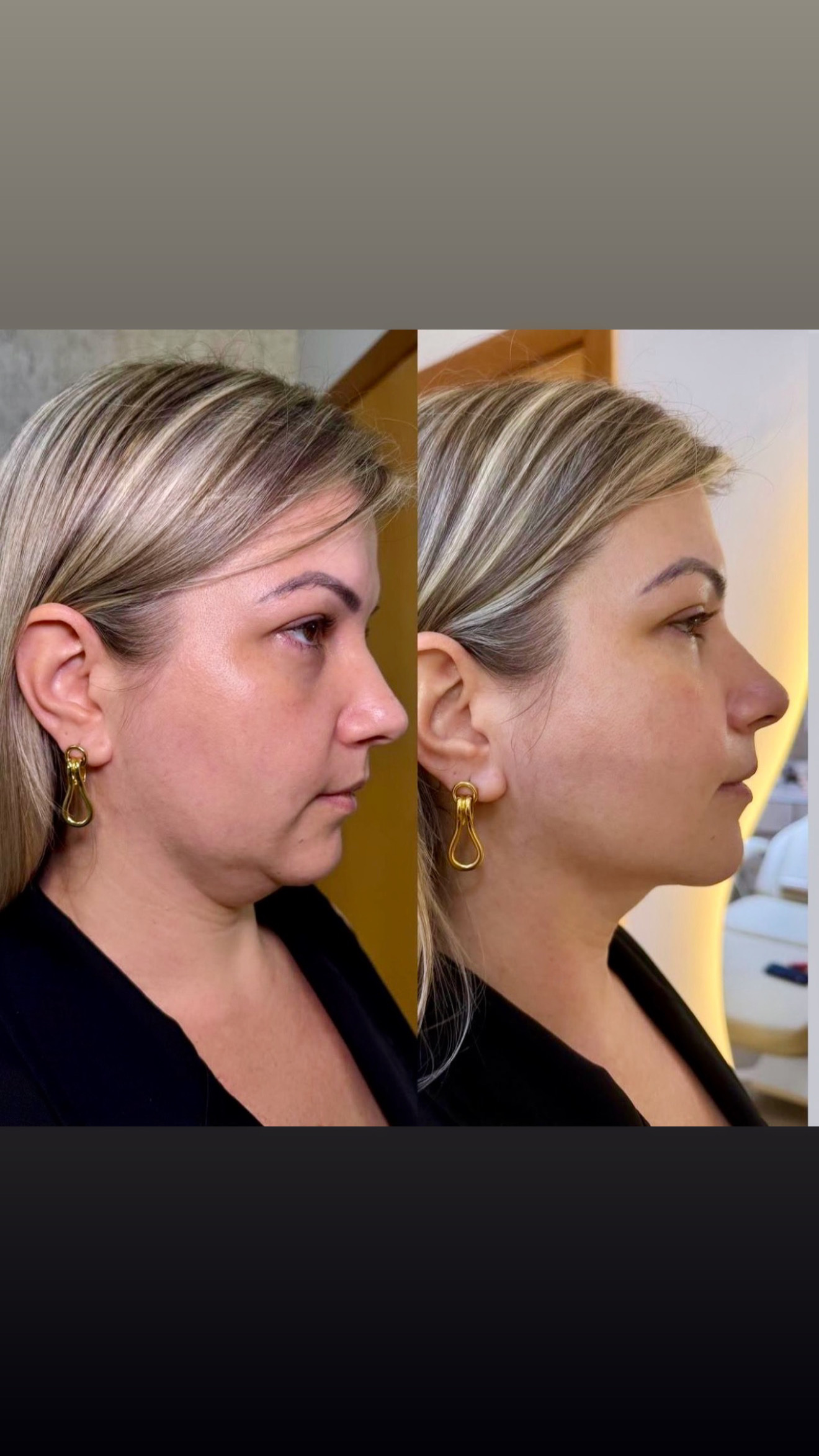 Resultado antes e depois
