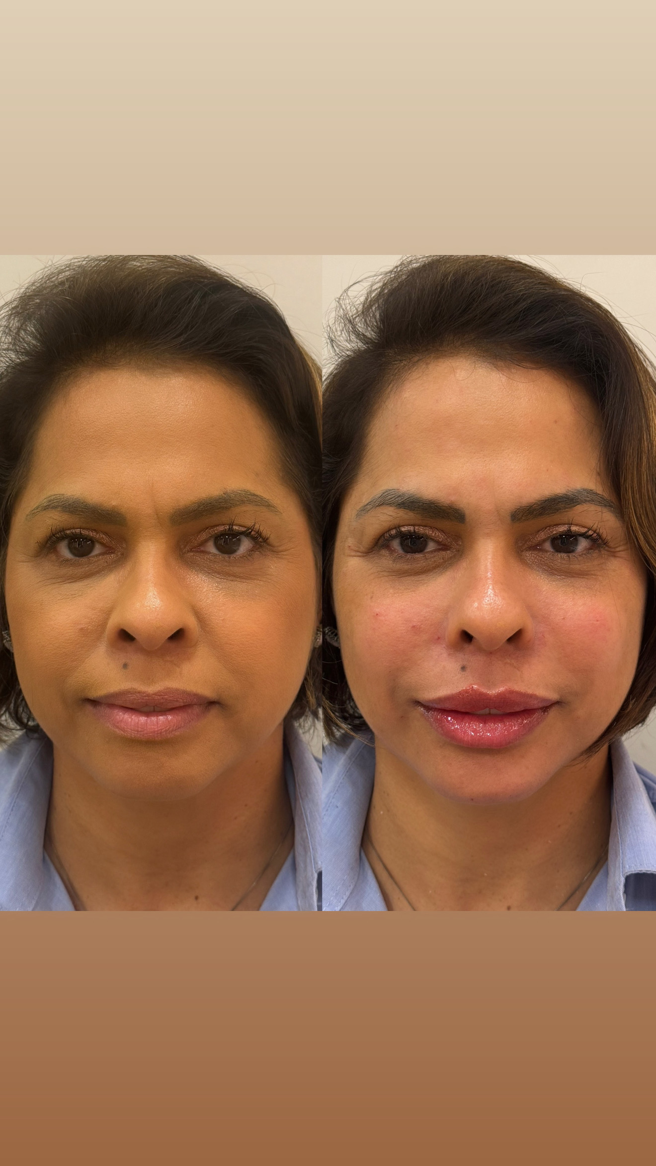 Resultado antes e depois
