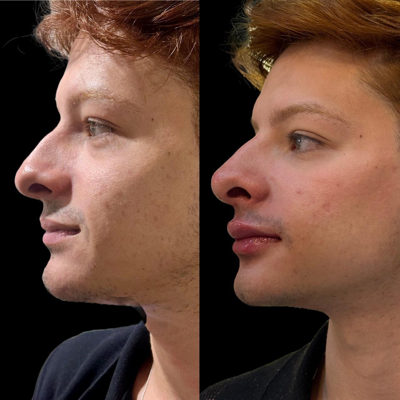 Resultado antes e depois