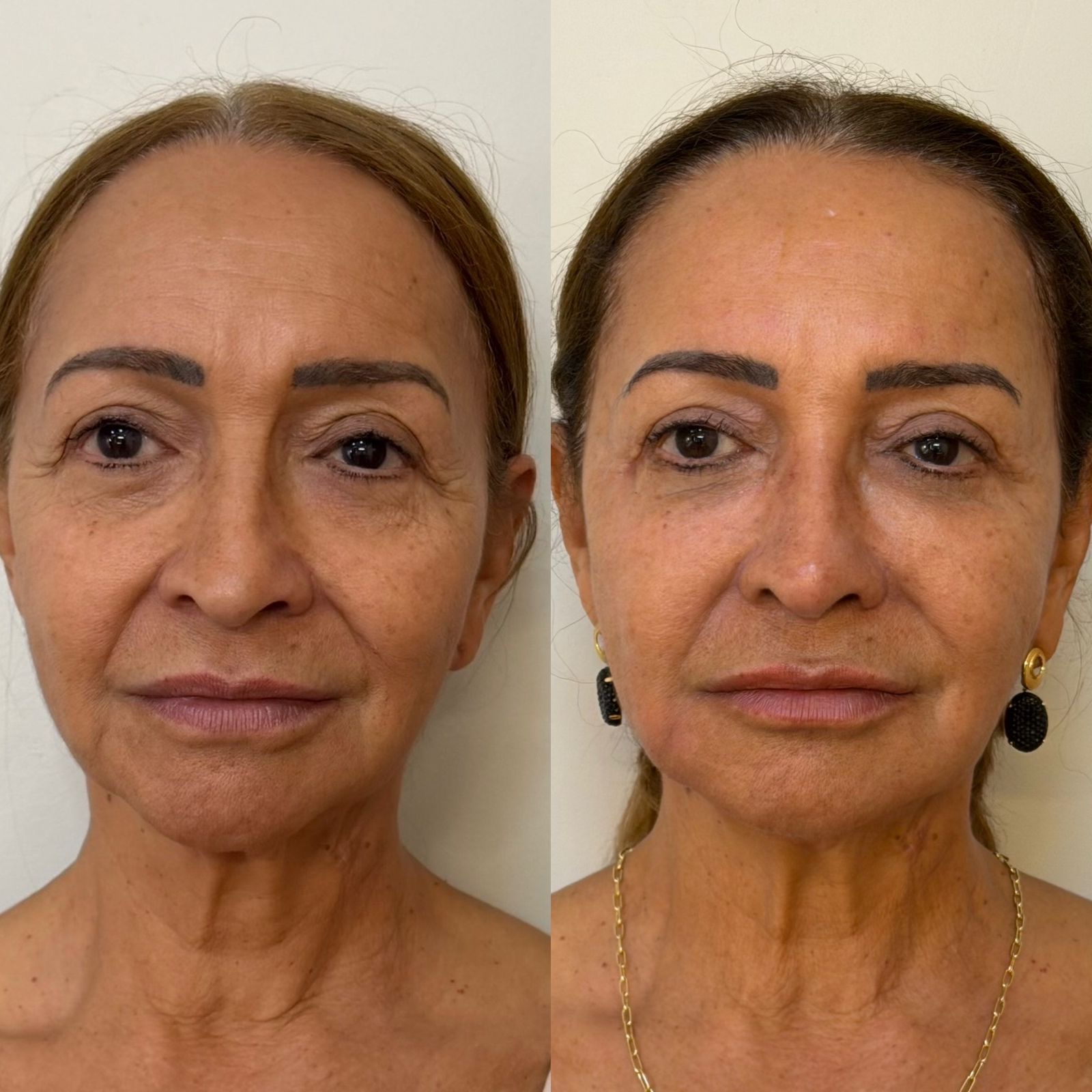 Resultado antes e depois