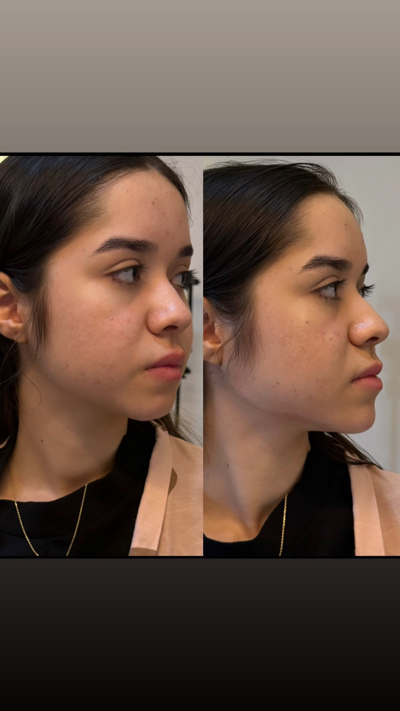 Resultado antes e depois